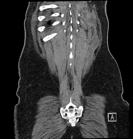 Closed loop obstruction - internal hernia into nephrectomy bed (Radiopaedia 59867-67320 B 132).jpg