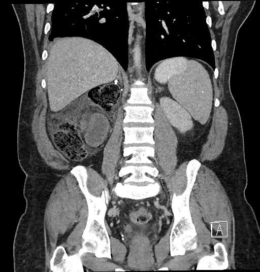 Closed loop obstruction - internal hernia into nephrectomy bed (Radiopaedia 59867-67320 B 95).jpg