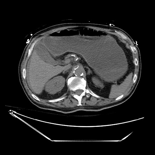 File:Closed loop obstruction due to adhesive band, resulting in small bowel ischemia and resection (Radiopaedia 83835-99023 Axial non-contrast 46).jpg