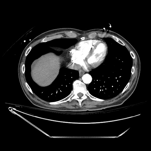 File:Closed loop obstruction due to adhesive band, resulting in small bowel ischemia and resection (Radiopaedia 83835-99023 B 16).jpg