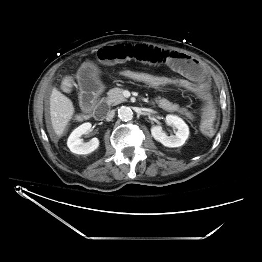 File:Closed loop obstruction due to adhesive band, resulting in small bowel ischemia and resection (Radiopaedia 83835-99023 D 62).jpg