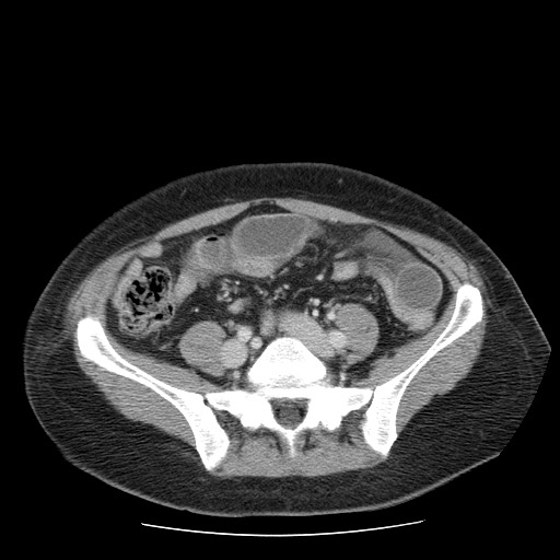 File:Closed loop small bowel obstruction (Radiopaedia 65403-74451 Axial 16).jpg