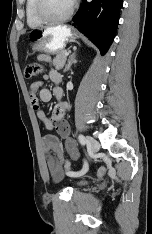 Closed loop small bowel obstruction - internal hernia (Radiopaedia 57806-64778 C 45).jpg