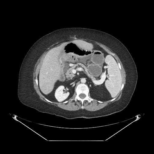 Closed loop small bowel obstruction - internal hernia (Radiopaedia 65402-74450 A 42).jpg