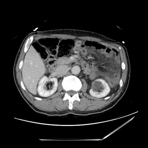 Closed loop small bowel obstruction - omental adhesion causing "internal hernia" (Radiopaedia 85129-100682 A 62).jpg