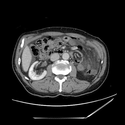 Closed loop small bowel obstruction - omental adhesion causing "internal hernia" (Radiopaedia 85129-100682 A 73).jpg