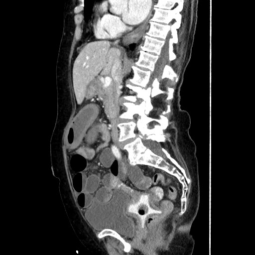 Closed loop small bowel obstruction due to adhesive band, with intramural hemorrhage and ischemia (Radiopaedia 83831-99017 D 99).jpg