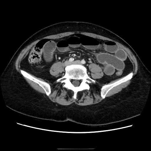 Closed loop small bowel obstruction due to adhesive bands - early and late images (Radiopaedia 83830-99015 A 107).jpg