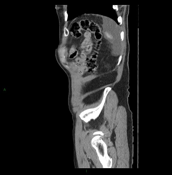 Closed loop small bowel obstruction with ischemia (Radiopaedia 84180-99456 C 80).jpg