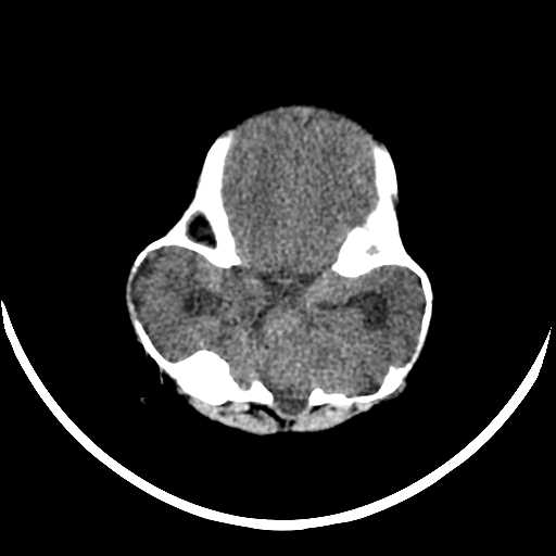 File:Cloverleaf shaped skull in the absence of craniosynostosis (Radiopaedia 21296-21216 Axial non-contrast 4).jpg