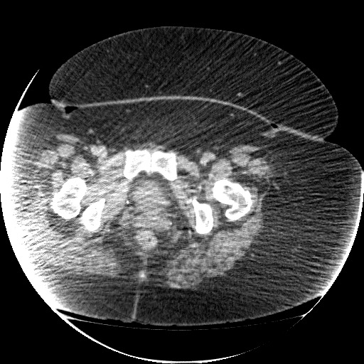 File:Collection due to leak after sleeve gastrectomy (Radiopaedia 55504-61972 A 80).jpg