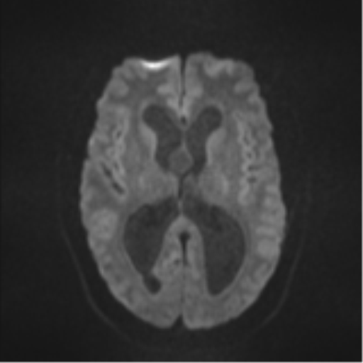 Colloid cyst (Radiopaedia 53164-59125 Axial DWI 42).png