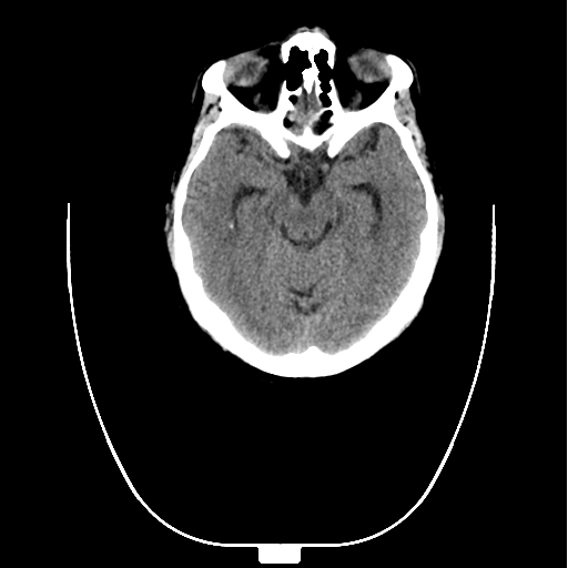 File:Colloid cyst of the third ventricle (Radiopaedia 86571-102661 B 1).png