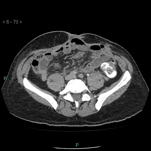File:Colo-cutaneous fistula (Radiopaedia 40531-43129 A 30).jpg