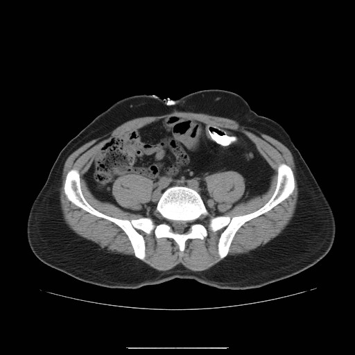 File:Colocutaneous fistula in Crohn's disease (Radiopaedia 29586-30093 D 21).jpg