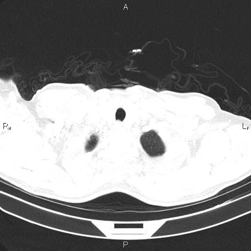 File:Colon cancer (Radiopaedia 85663-101443 Axial lung window 3).jpg