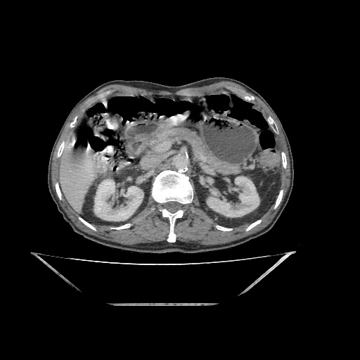Colon cancer (ultrasound) (Radiopaedia 77249-89300 A 52).jpg