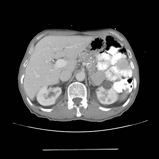 File:Colon cancer with calcified liver metastasis (Radiopaedia 74423-85307 A 22).jpg