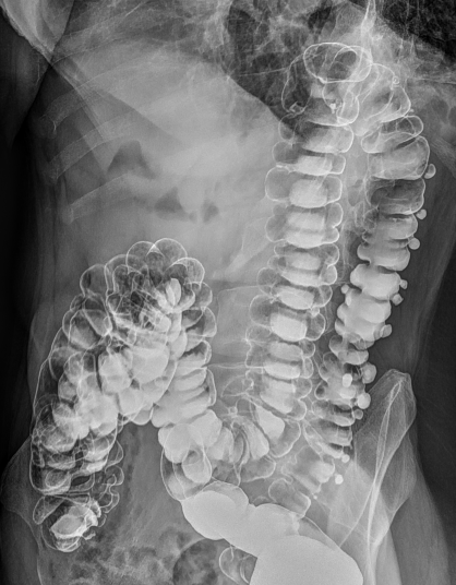 File:Colonic diverticulosis (Radiopaedia 59378-66739 C 1).PNG