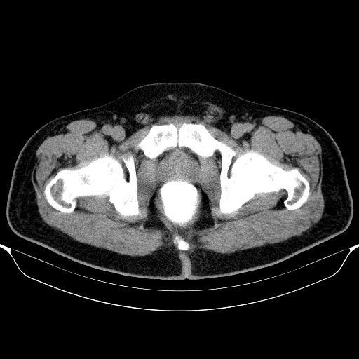 Colonic lipoma with colo-colic intussusception (Radiopaedia 58944-66200 Axial C+ rectal 74).jpg