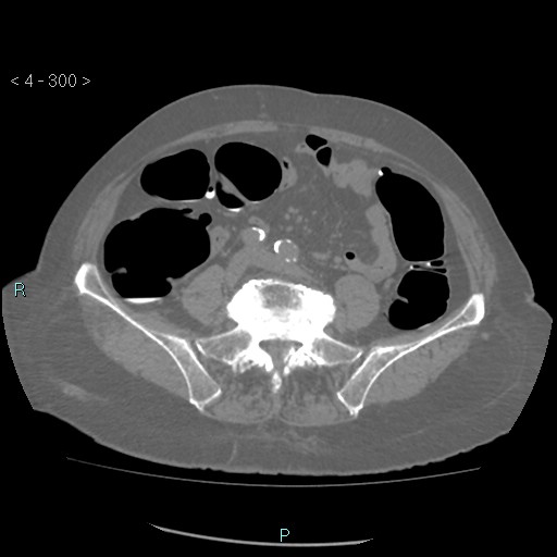 Colonic lipomas (Radiopaedia 49137-54244 Axial bone window 134).jpg