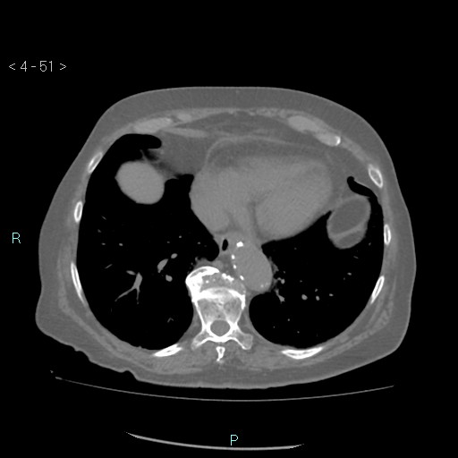 File:Colonic lipomas (Radiopaedia 49137-54244 Axial bone window 23).jpg