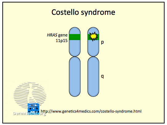 File:Costello Syndrome (DermNet NZ Costello-Syndrome).png
