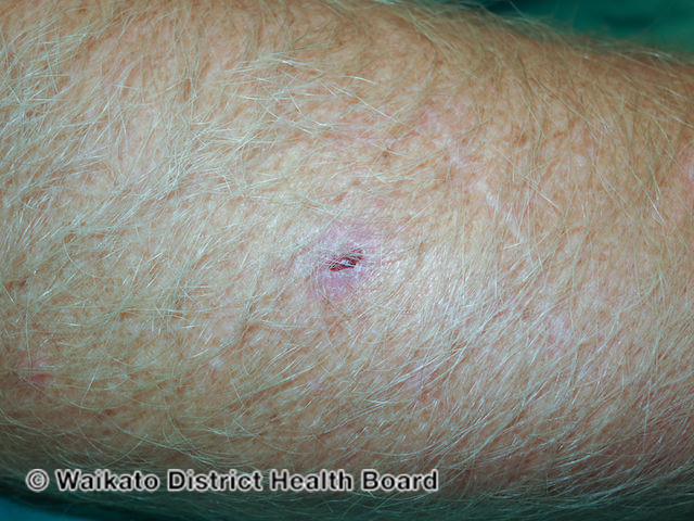File:Eroding basal cell carcinoma, arm (DermNet NZ ebcc-arm-3-wdhb).jpg
