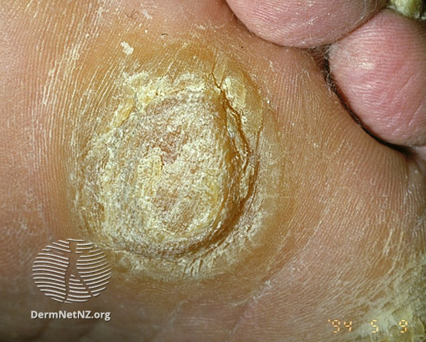 File:Focal palmoplantar keratoderma (DermNet NZ scaly-s-focal-kd3).jpg