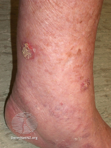 Intraepidermal carcinoma (DermNet NZ lesions-scc-in-situ-2982).jpg