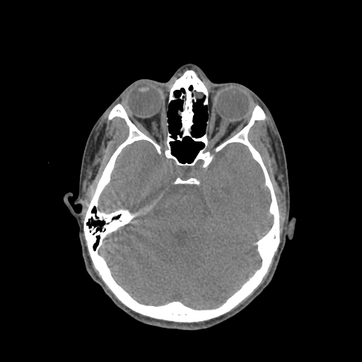 Nasal pyogenic granuloma (lobular capillary hemangioma) (Radiopaedia 85536-101244 Axial non-contrast 100).jpg