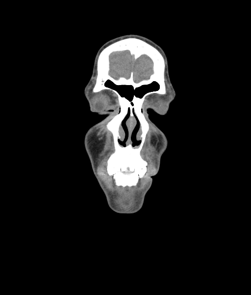 File:Nasal pyogenic granuloma (lobular capillary hemangioma) (Radiopaedia 85536-101244 Coronal non-contrast 52).jpg