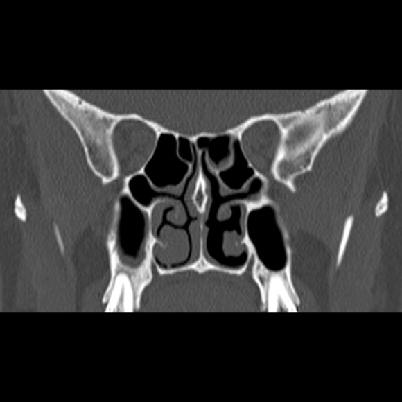 Nasal septal perforation (Radiopaedia 25030-25289 Coronal bone window 45).jpg