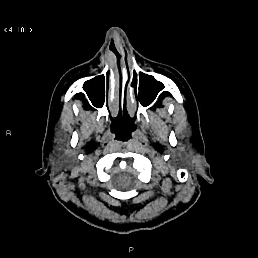 Nasolabial cyst (Radiopaedia 75125-86194 Axial non-contrast 63).jpg
