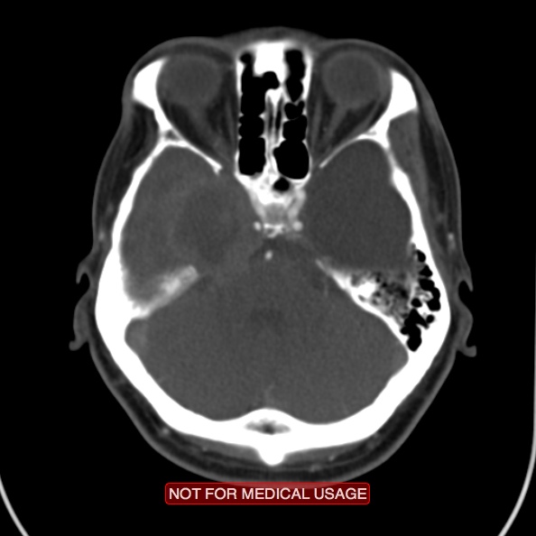 File:Nasopharyngeal carcinoma recurrence - skull base destruction (Radiopaedia 29107-29491 A 3).jpg