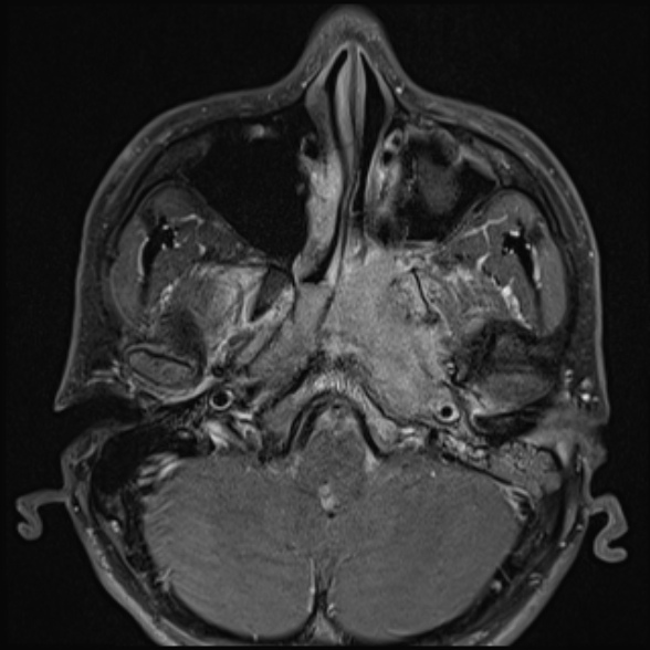 File:Nasopharyngeal carcinoma with skull base invasion (Radiopaedia 53415-59485 Axial T1 C+ fat sat 24).jpg