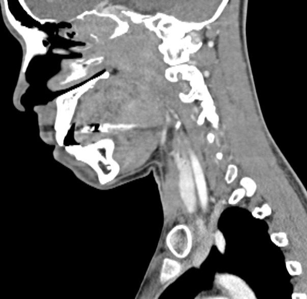 Nasopharyngeal carcinoma with skull base invasion (Radiopaedia 53415-59705 C 44).jpg
