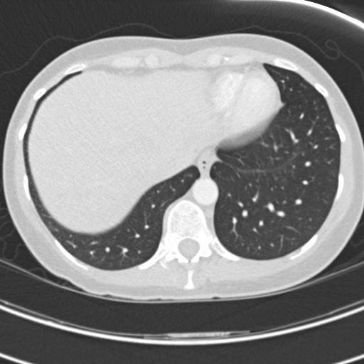 File:Necrobiotic pulmonary nodules - Crohn disease (Radiopaedia 20723-20631 Axial lung window 116).jpg