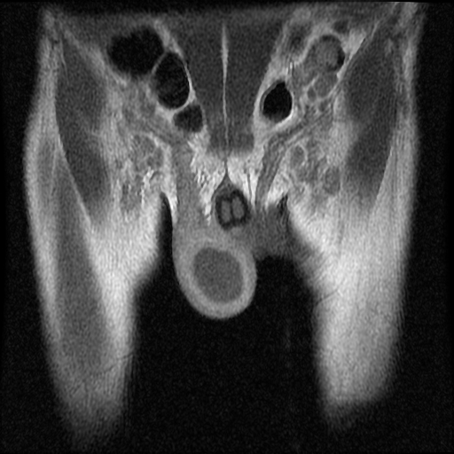 File:Necrotizing epididymo-orchitis with intra-testicular abscess (Radiopaedia 29397-29860 Coronal T1 C+ 6).jpg