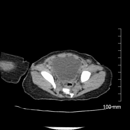File:Neonatal neuroblastoma (Radiopaedia 56651-63438 Axial non-contrast 70).jpg