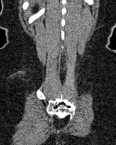 File:Nephrostomy for urosepsis (Radiopaedia 26180-26330 non-contrast 79).jpg
