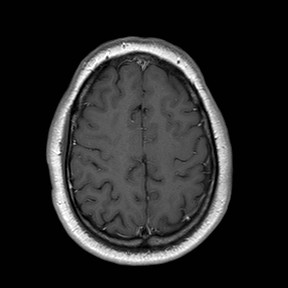 File:Neuro-Behcet's disease (Radiopaedia 21557-21506 Axial T1 C+ 22).jpg