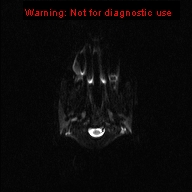 File:Neurofibromatosis type 1 with optic nerve glioma (Radiopaedia 16288-15965 Axial DWI 23).jpg