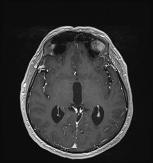 Neurofibromatosis type 2 (Radiopaedia 79097-92049 Axial T1 C+ 100).jpg