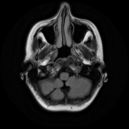 File:Neurofibromatosis type 2 - bilateral acoustic neuromata (Radiopaedia 40060-42566 Axial FLAIR 3).png