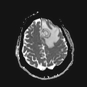 File:Neurotoxoplasmosis - concentric target sign (Radiopaedia 70644-80784 Axial ADC 18).jpg