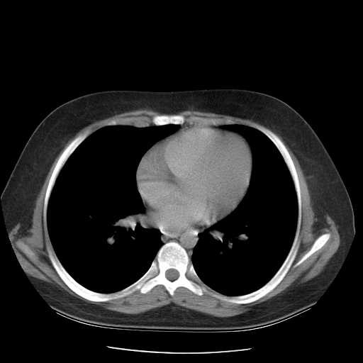 File:Non-Hodgkin lymphoma involving pelvis (Radiopaedia 21281-21197 B 1).jpg