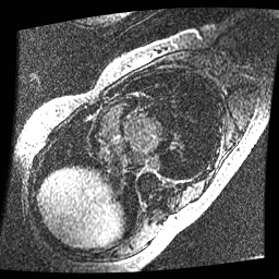 File:Non-compaction of the left ventricle (Radiopaedia 38868-41062 E 13).jpg