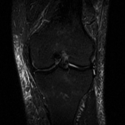 File:Non-displaced patella fracture (Radiopaedia 15932-15582 Coronal STIR 13).jpg