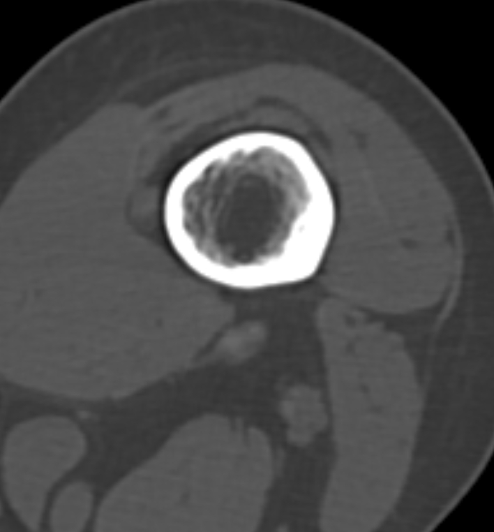 Non-ossifying fibroma - femur (Radiopaedia 82786-97042 Axial bone window 35).jpg